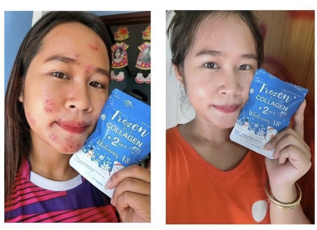 Ultimate Glow Set: Frozen Detox & Collagen Whitening x10 Glutathione
