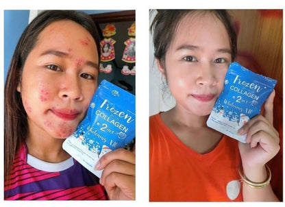 Ultimate Glow Set: Frozen Detox & Collagen Whitening x10 Glutathione